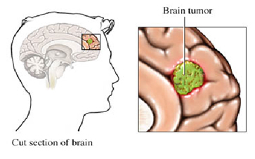 India Brain Surgery Hospital, Brain Tumors Treatment India Brain Tumors, India Brain, India Tumors, India Brain Problems